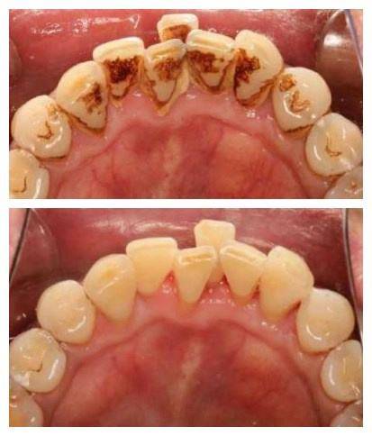 南山罗湖洁牙199元抢2320元鹏爱口腔成人洁牙补牙套餐