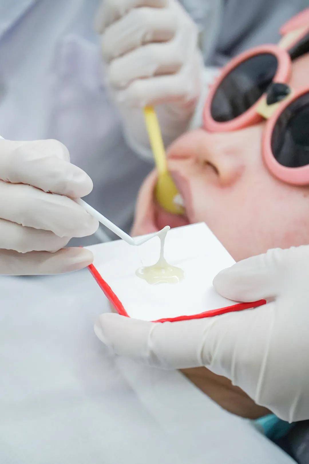 涂氟形成一层牙齿的"保护膜"增强牙齿的抗龋能力对宝宝的牙齿加强钙化